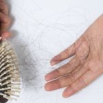 Malattie dei capelli: alopecia areata  